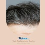 Hair Replacement System